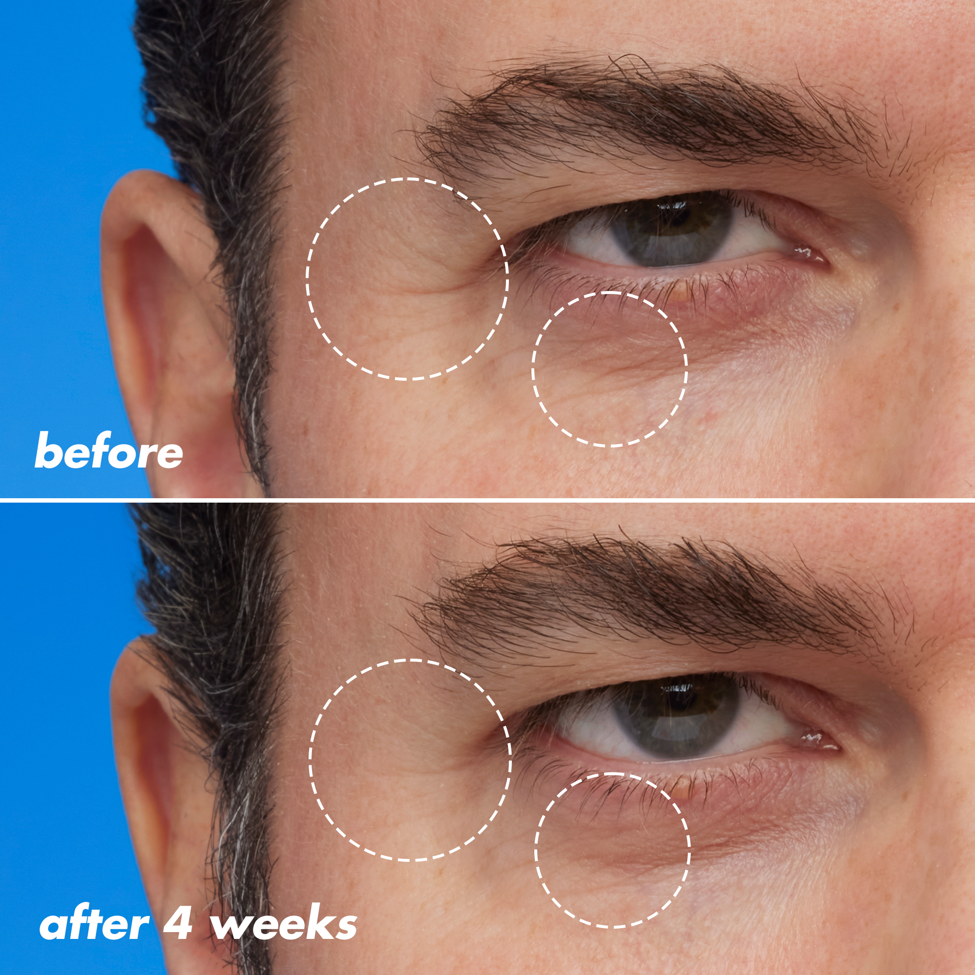 Fine Line and Wrinkles Before and After Using Retinoid Face Oil for Four Weeks